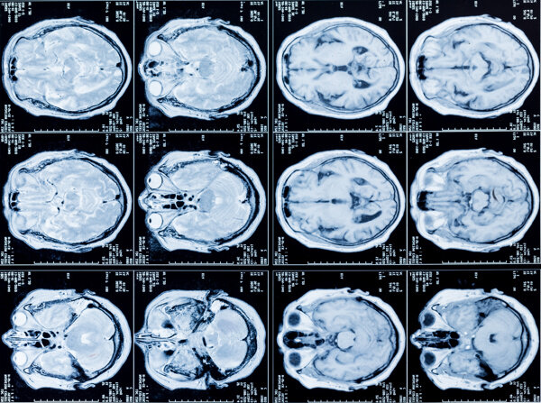 大脑CT片图片