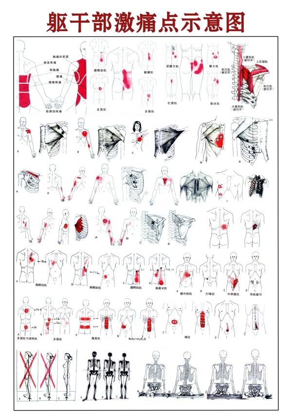 躯干部激痛点示意图