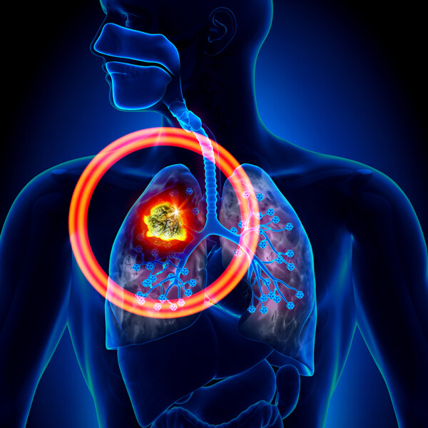 肺癌信号图片